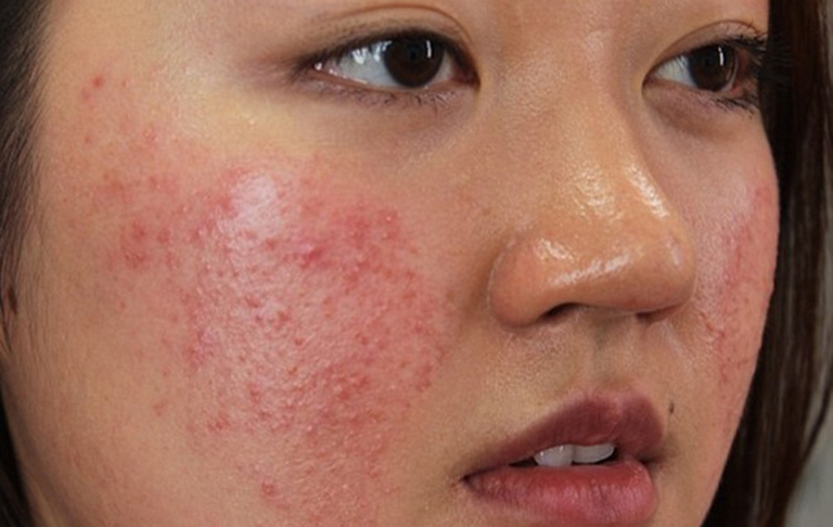 Dị ứng thời tiết lạnh nổi mẩn đỏ