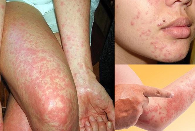 Dị ứng thời tiết lạnh nổi mẩn đỏ