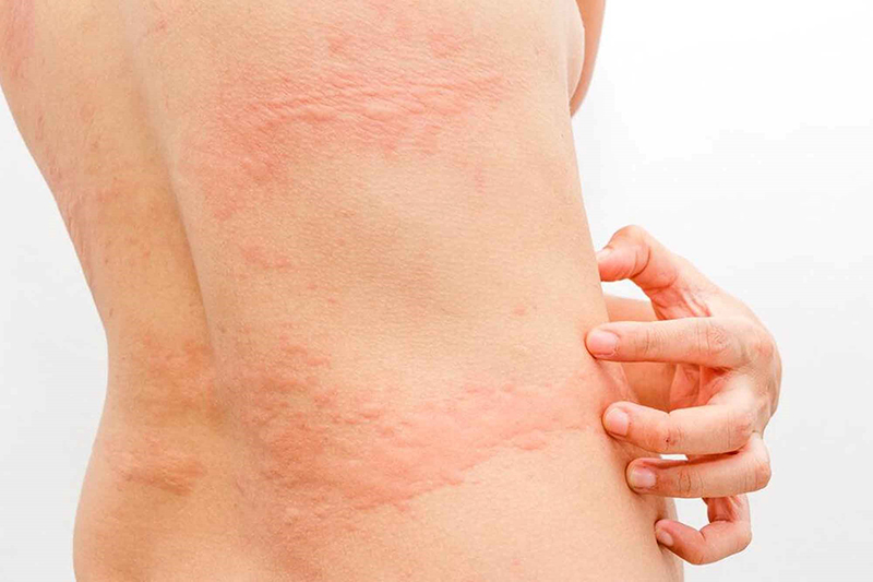 Dị ứng thời tiết lạnh nổi mẩn đỏ