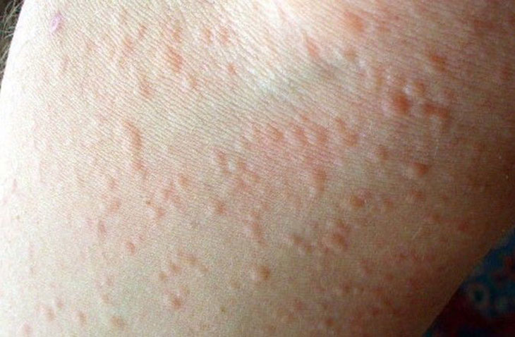 Dị ứng thời tiết lạnh nổi mẩn đỏ