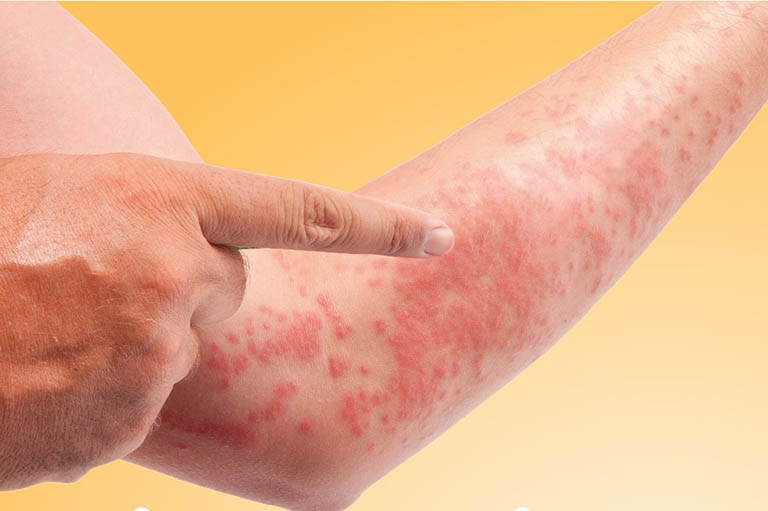 dị ứng thời tiết lạnh nổi mẩn đỏ