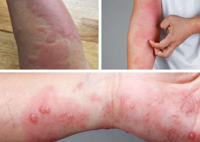 Dị Ứng Thời Tiết Bao Lâu Thì Khỏi? Nguyên Nhân Và Biểu Hiện Của Nó